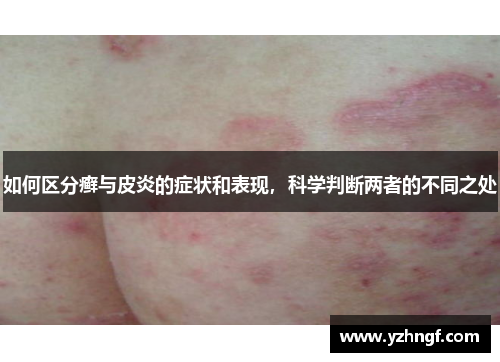 如何区分癣与皮炎的症状和表现，科学判断两者的不同之处